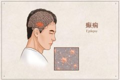 黑龙江省治疗癫痫好医院